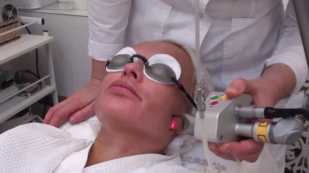 Behandlung mit einem Laserstrahl von Problembereichen der Gesichtshaut