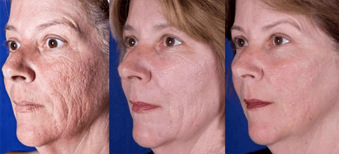 Ergebnis nach Laser-Gesichtshautverjüngung