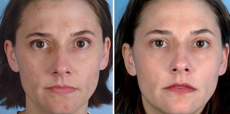 vor und nach der Hautverjüngung mit dem Gerät