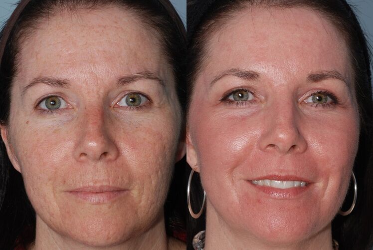vor und nach der Hautverjüngung